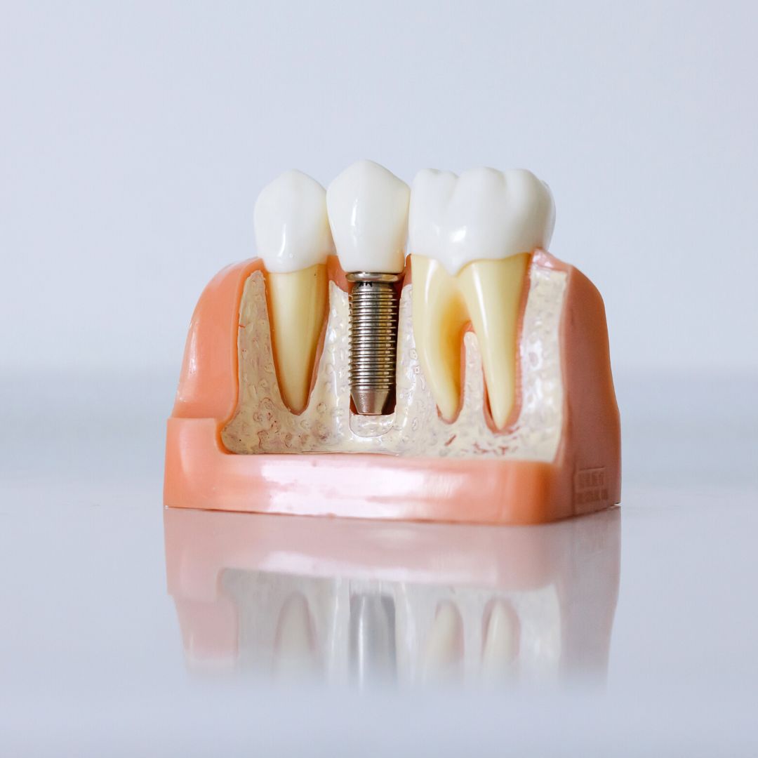 providente-imagem-implante-dentario