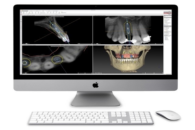 Implante Protese Protocolo com cirurgia guiada